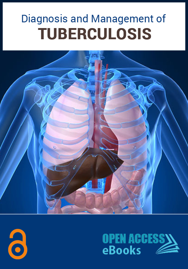 diagnosis-management-tuberculosis