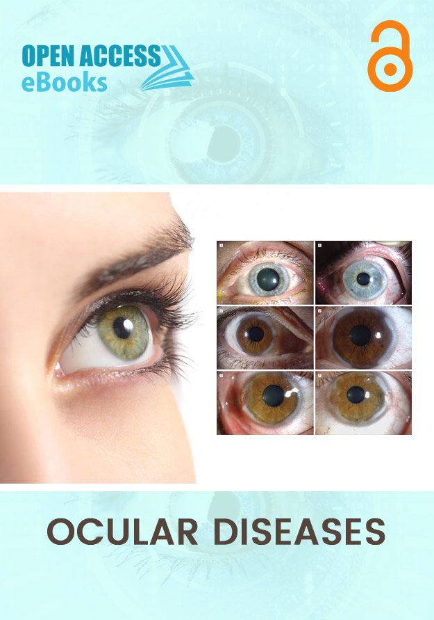 Ocular Diseases